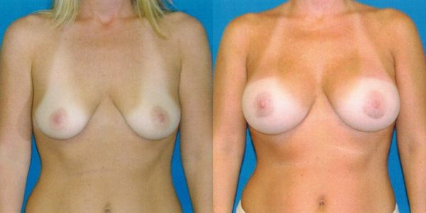 Breast Augmentation Before and After Patient 62 8