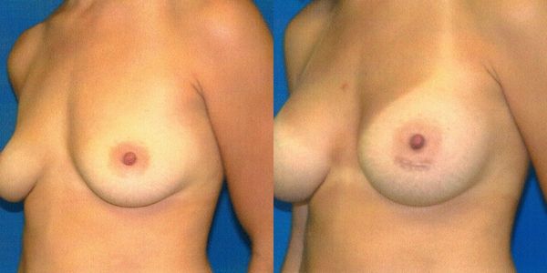 Breast Augmentation Before and After Patient 63 5