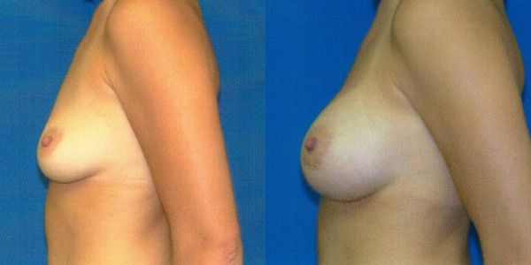 Breast Augmentation Before and After Patient 63 4
