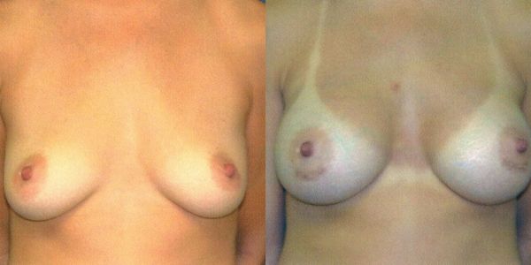 Breast Augmentation Before and After Patient 63 6