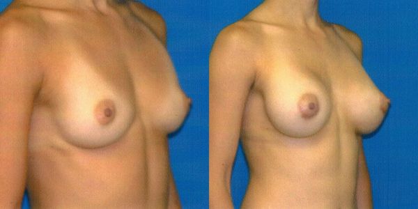 Breast Augmentation Before and After Patient 64 2
