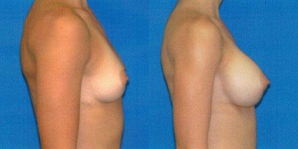 Breast Augmentation Before and After Patient 64