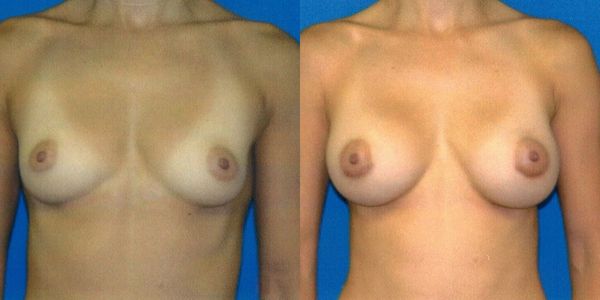 Breast Augmentation Before and After Patient 64 3
