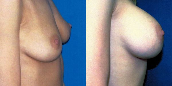 Breast Augmentation Before and After Patient 65