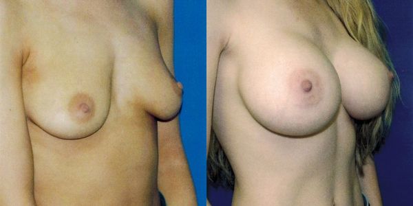 Breast Augmentation Before and After Patient 65 2