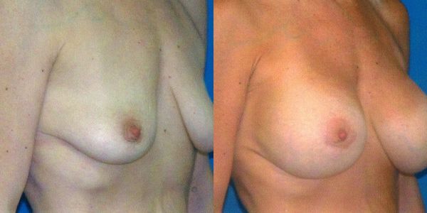 Breast Augmentation Before and After Patient 66 2