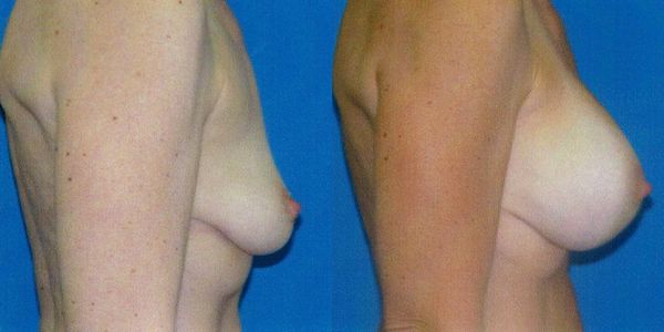 Breast Augmentation Before and After Patient 66