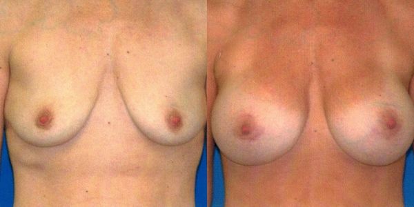 Breast Augmentation Before and After Patient 66 3