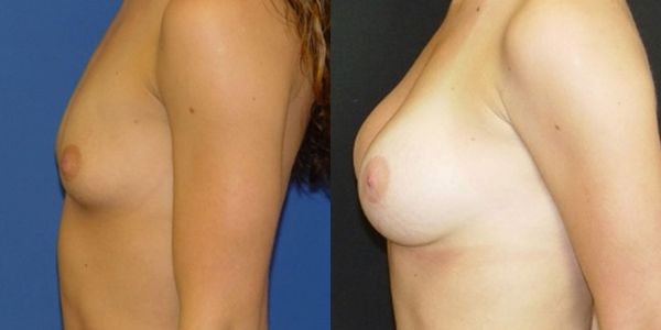 Breast Augmentation Before and After Patient 67