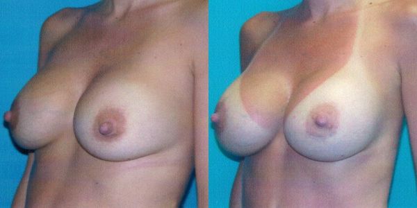 Breast Augmentation Before and After Patient 68 2