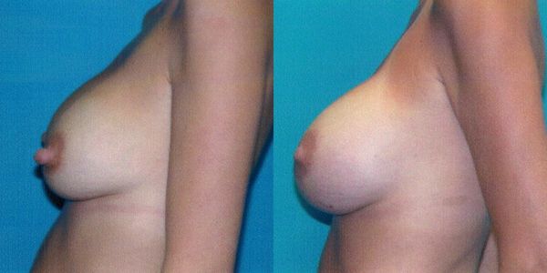 Breast Augmentation Before and After Patient 68