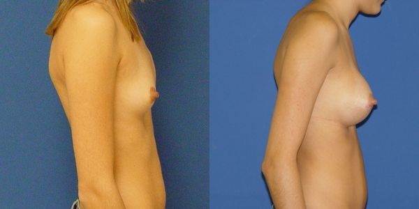 Breast Augmentation Before and After Patient 69 2