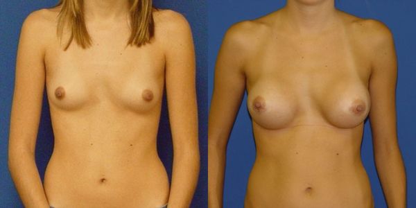 Breast Augmentation Before and After Patient 69 4