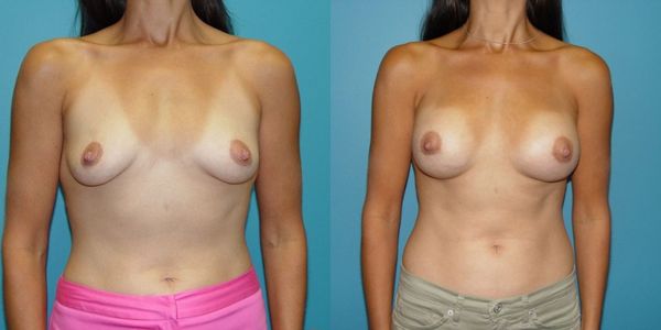 Breast Augmentation Before and After Patient 70 4