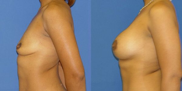 Breast Augmentation Before and After Patient 71 3