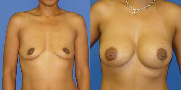Breast Augmentation Before and After Patient 71 2
