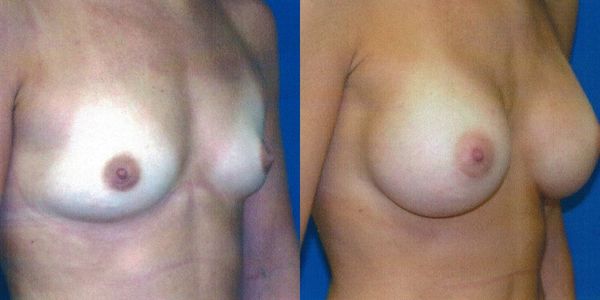 Breast Augmentation Before and After Patient 72 2