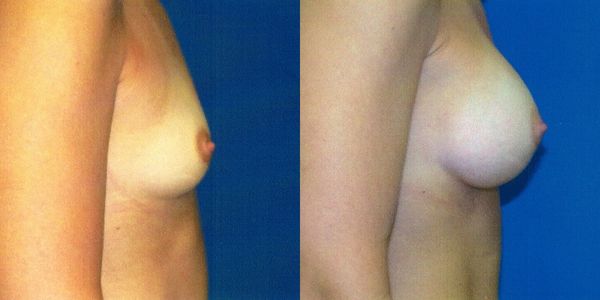 Breast Augmentation Before and After Patient 72