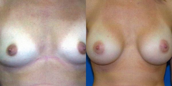 Breast Augmentation Before and After Patient 72 3