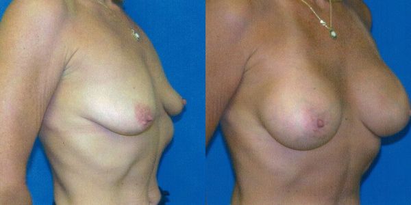 Breast Augmentation Before and After Patient 73 3