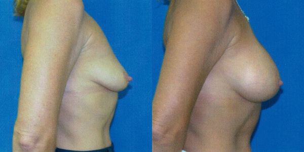 Breast Augmentation Before and After Patient 73 2