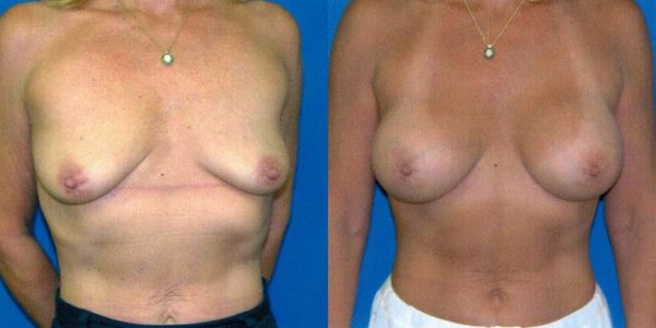 Breast Augmentation Before and After Patient 73
