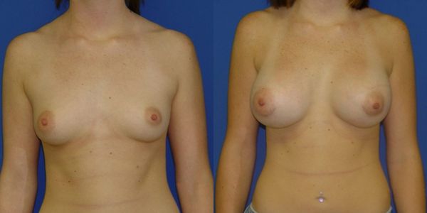 Breast Augmentation Before and After Patient 77 3