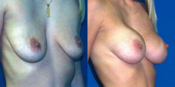 Breast Augmentation Before and After Patient 86 2