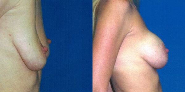 Breast Augmentation Before and After Patient 86