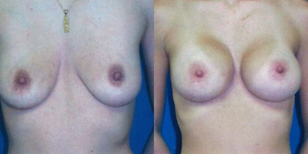 Breast Augmentation Before and After Patient 86 3