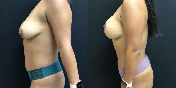 Breast Augmentation & Lift Before and After Patient 147 (3)