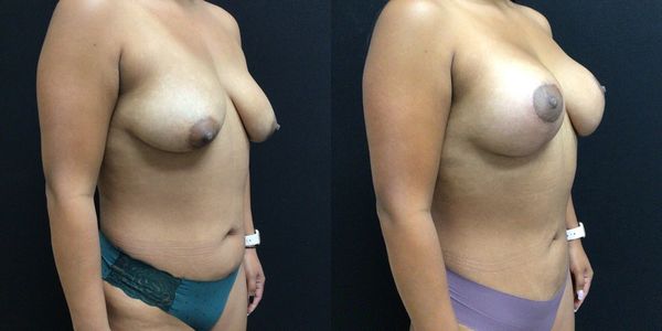 Breast Augmentation & Lift Before and After Patient 147 (4)