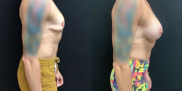 Breast Augmentation & Lift Before and After Patient 148 3