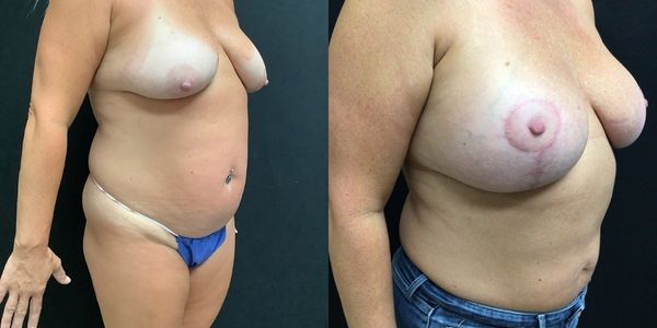 Breast Augmentation & Lift Before and After Patient 150 5