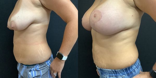 Breast Augmentation & Lift Before and After Patient 151 (4)