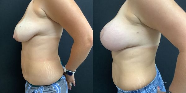 Breast Augmentation & Lift Before and After Patient 151 3