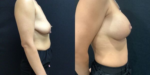 Breast Augmentation & Lift Before and After Patient 152 3