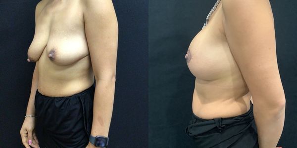 Breast Augmentation & Lift Before and After Patient 152