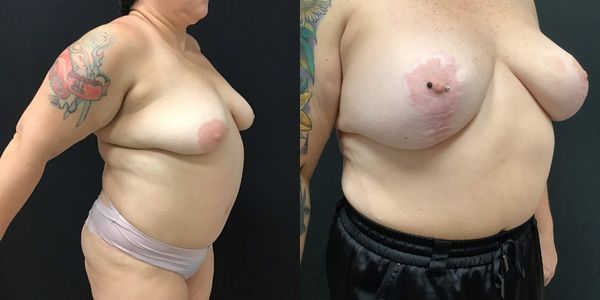 Breast Augmentation & Lift Before and After Patient 171