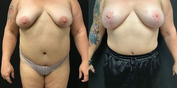 Breast Augmentation & Lift Before and After Patient 171 2