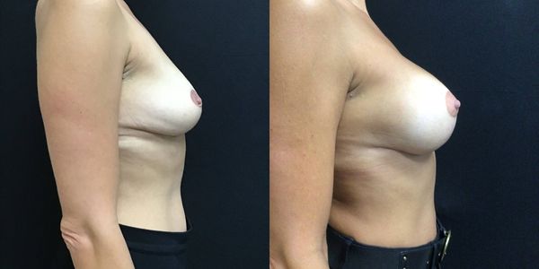 Breast Augmentation & Lift Before and After Patient 188 2