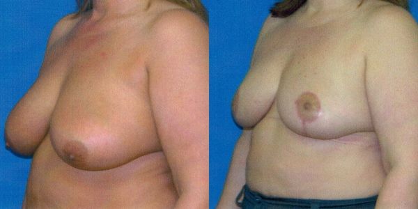 Breast Lift Before and After Patient 100