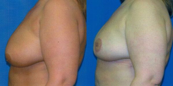 Breast Lift Before and After Patient 100 3