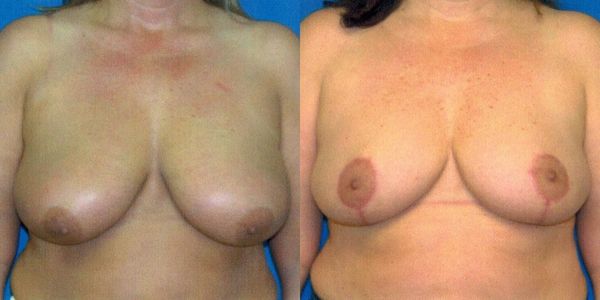 Breast Lift Before and After Patient 100 2