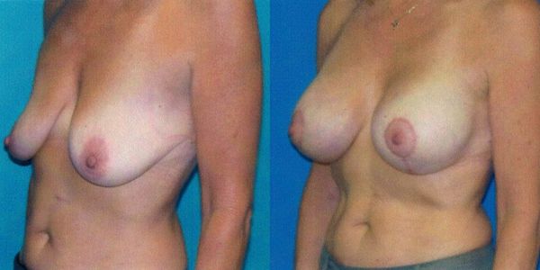 Breast Lift Before and After Patient 101 2