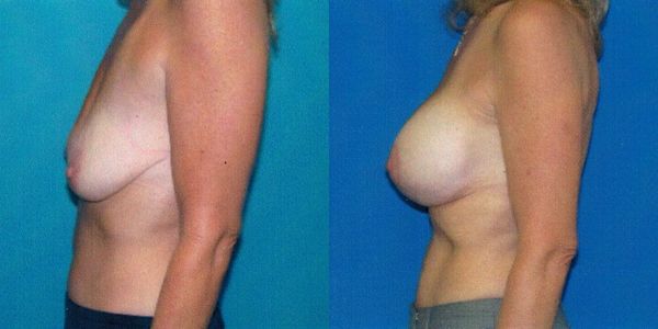 Breast Lift Before and After Patient 101
