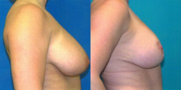 Breast Reduction Before and After Patient 102 2