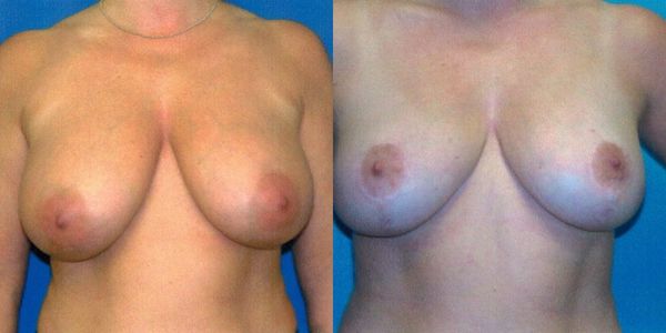 Breast Reduction Before and After Patient 102