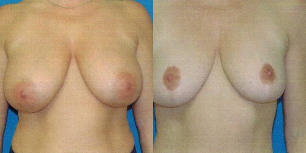 Breast Reduction Before and After Patient 103 3