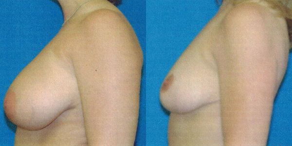 Breast Reduction Before and After Patient 103 2